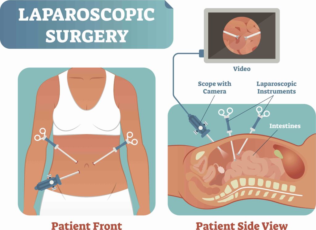 ენდომეტრიოზი და ლაპარასკოპია